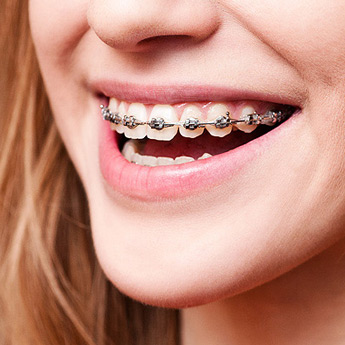 Close up of young girl's mouth with braces