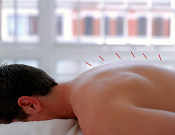 man receiving acupuncture with needles in his back